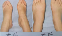 拇外翻手术过程视频,专业解析与康复指导